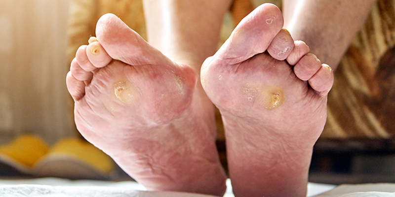 Ποδολογική φροντίδα για άτομα με διαβήτη.