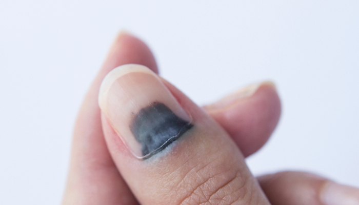 Τραυματισμός των ονύχων.