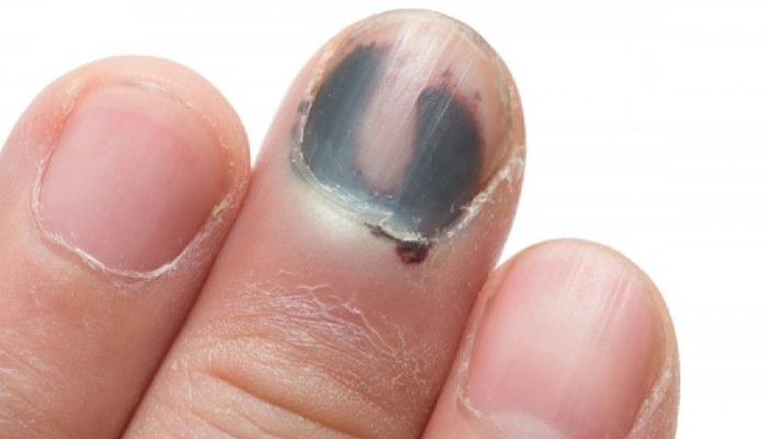 Τραυματισμός των ονύχων.