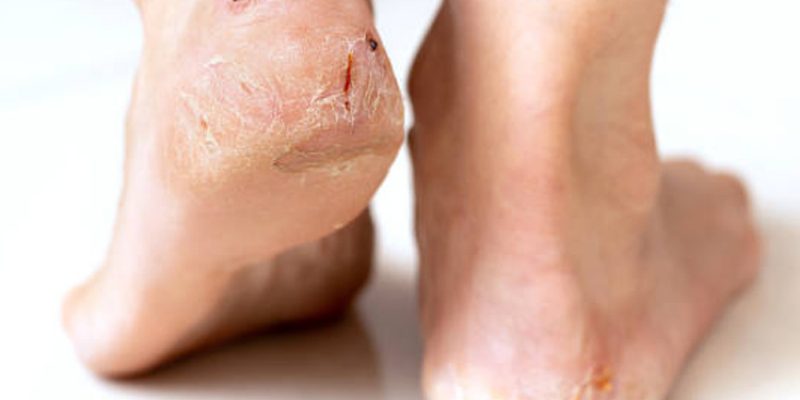 Ραγάδες Πέλματος.